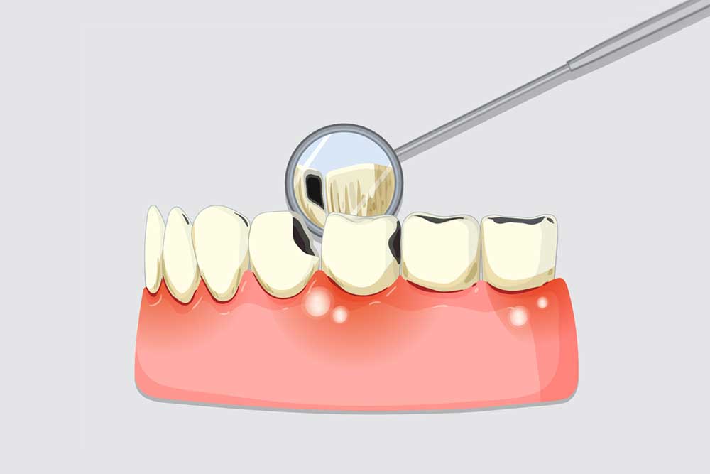 Teeth Sealants