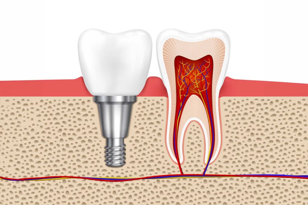Root Canal Treatment