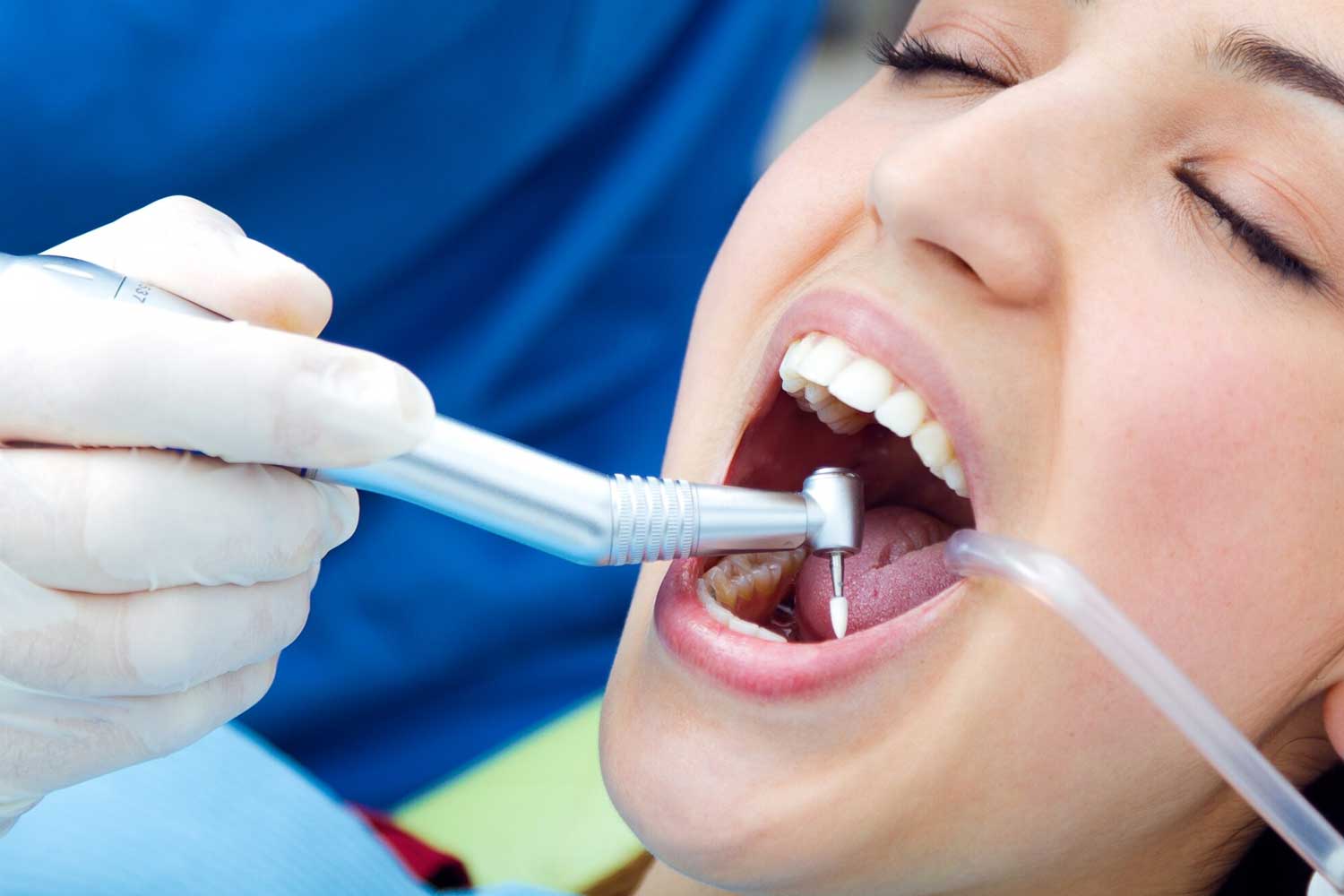 Dental Sealants