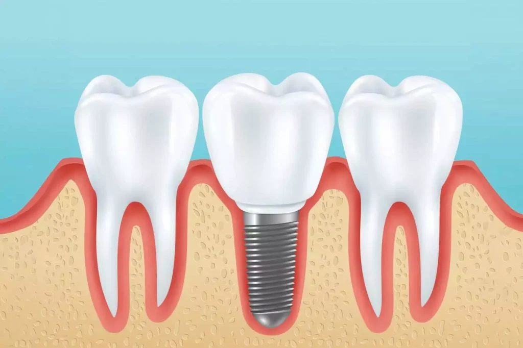 Dental Implant