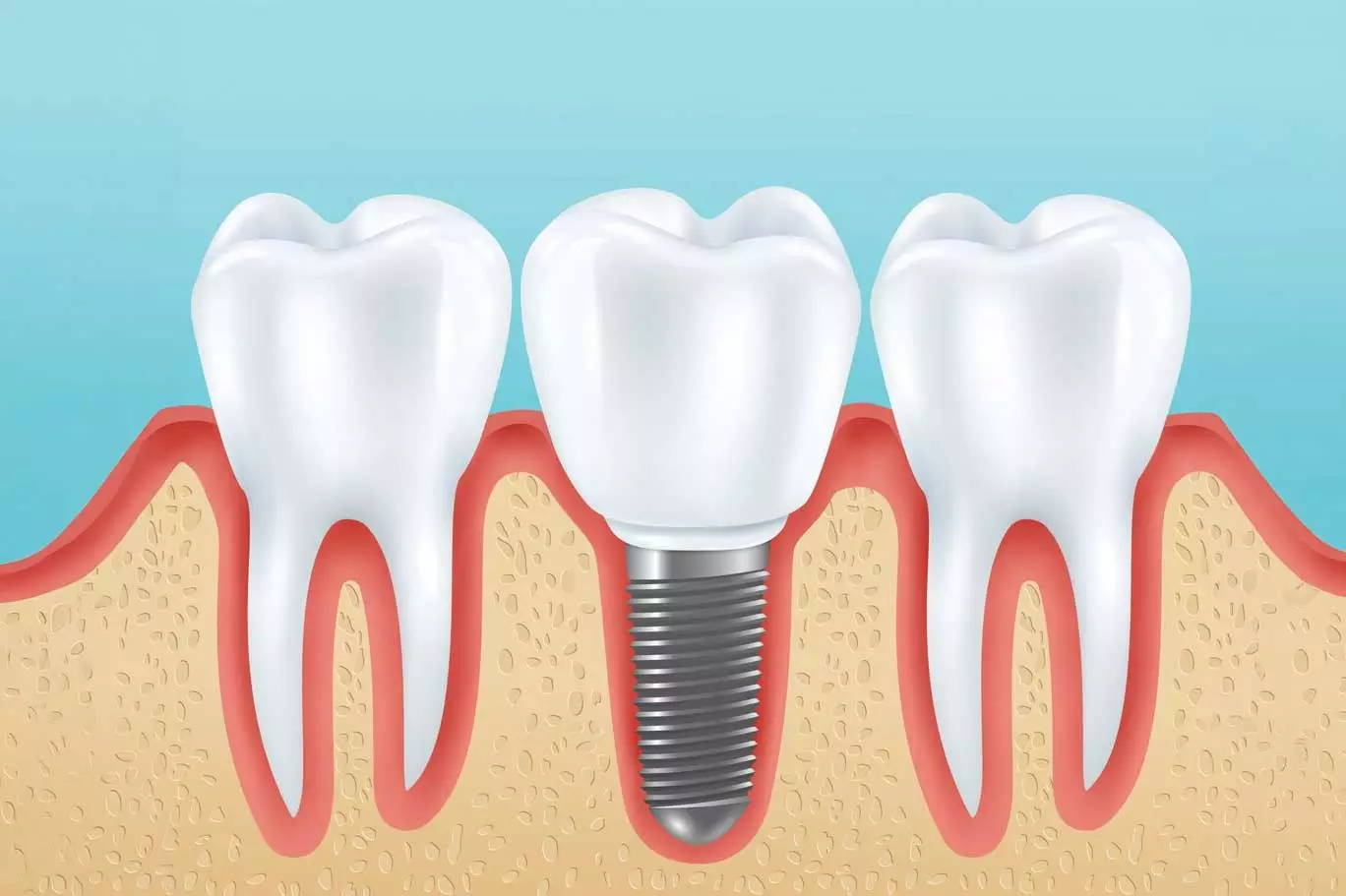 Dental Implant